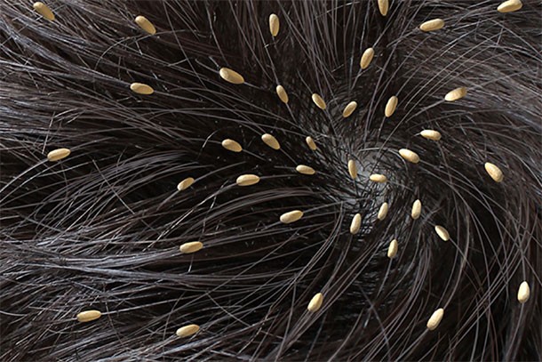 You are currently viewing How to Spot Lice in Blonde Hair, Even If You Can’t See Them